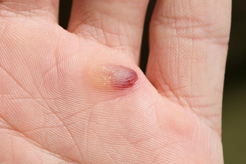 Blood blisters: Causes, diagnosis, and treatment HD wallpaper