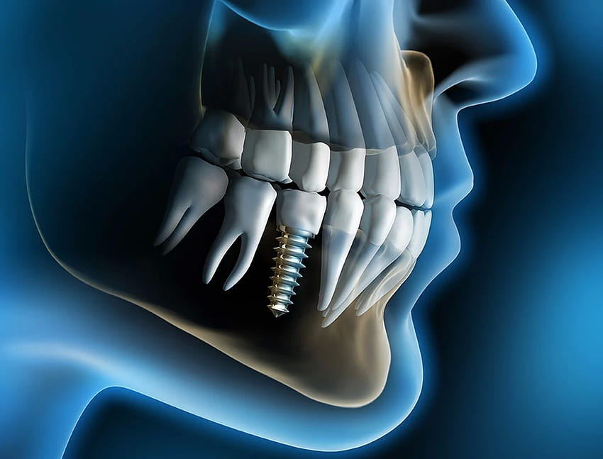 Implants dentaires et prothèses Fond d'écran HD