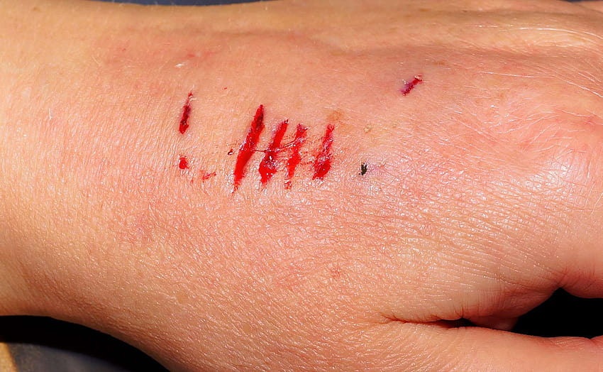 back of the hand, bite, blood, cracks, deep scratches, dog bite, fear, hand, injured, injury, painful, skin, wounding HD wallpaper
