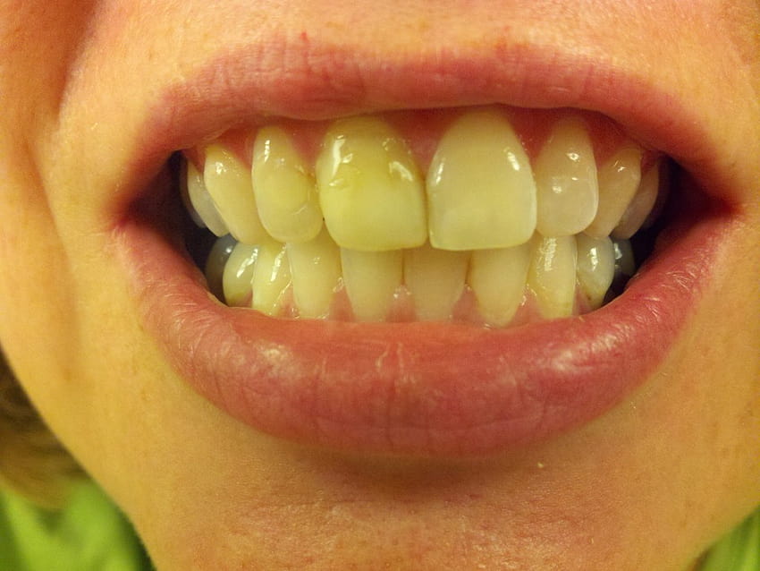 Dental Associates of West Michigan, dentes amarelos papel de parede HD
