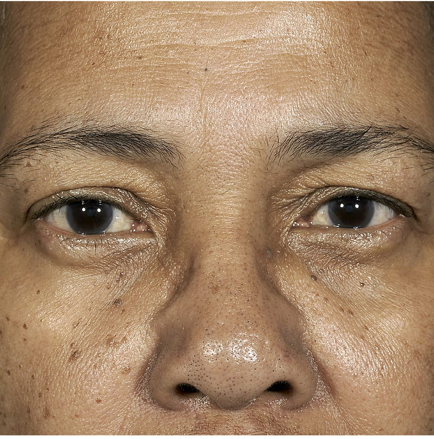 Eyelid Surgery Before and After by Mark McRae, MD, FRCS HD phone wallpaper