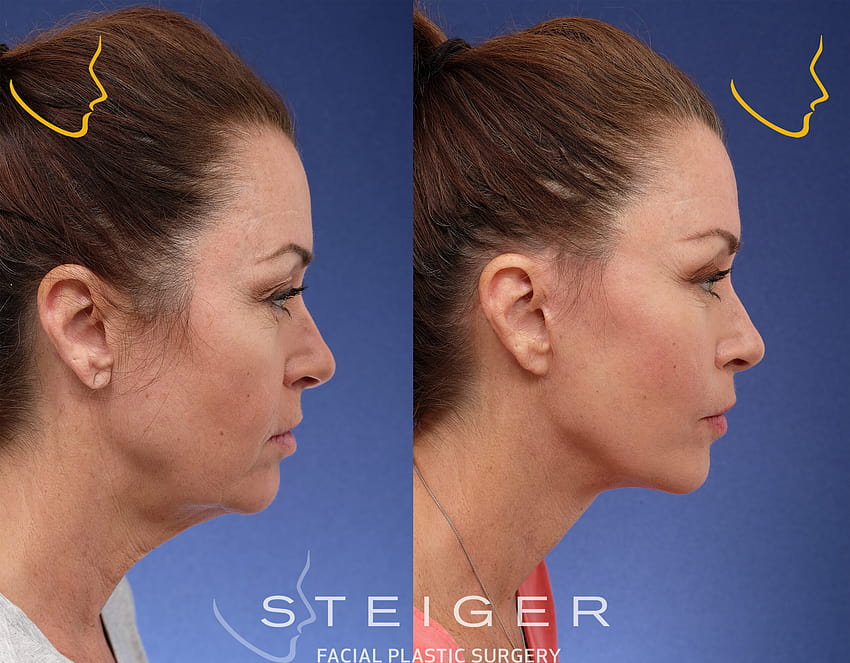 Facelift Before and After HD wallpaper | Pxfuel