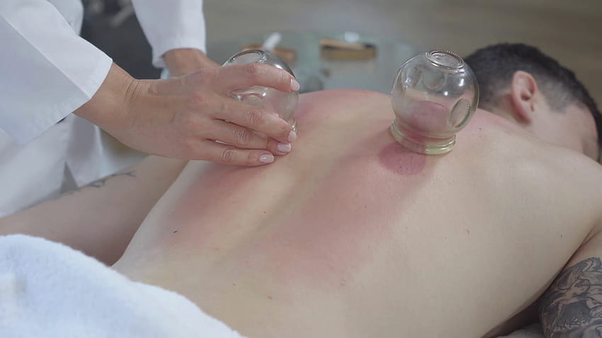Kadın akupunkturcu genç beyaz esmer adamın arkasından bardakları çıkarıyor. Geleneksel Asya tıbbıyla kas ağrısını iyileştiren profesyonel doktor. Sırt ağrısı tedavisi, çukurluğu. Stok Video i, kupa terapisi HD duvar kağıdı