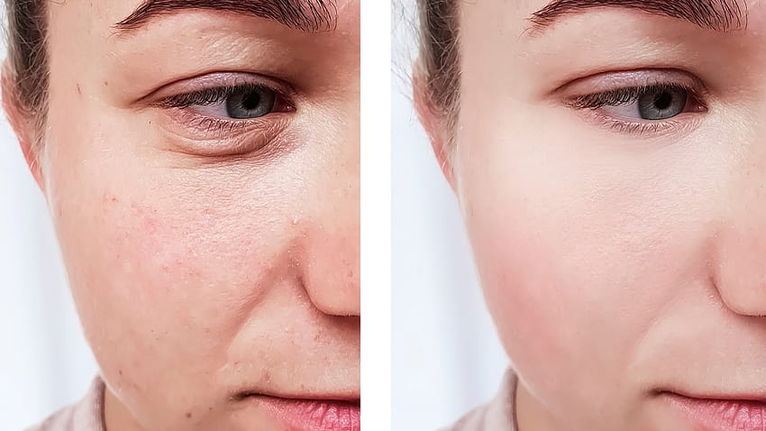 Hyaluronic Acid Serum Is Producing Amazing Before and After HD ...