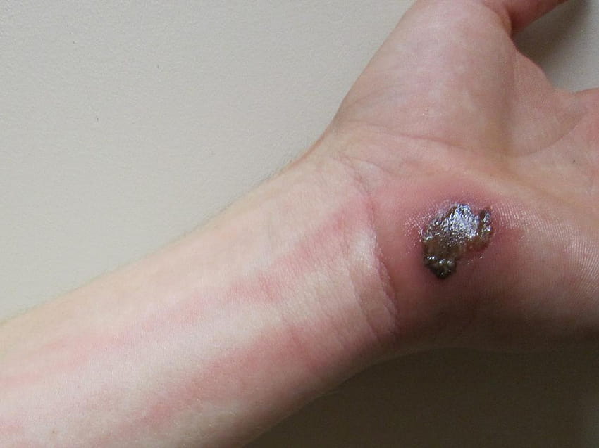 Should You Burst An Insect Bite Blister