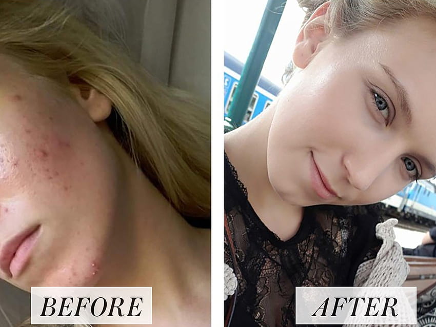 Woman's Before and After Accutane Go Viral on Reddit HD wallpaper