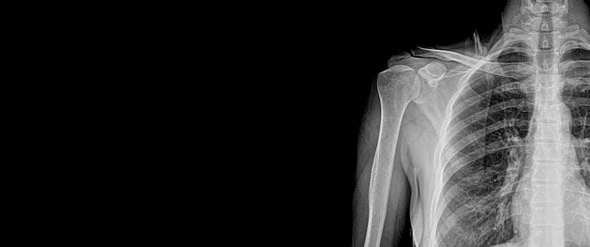 x ray ,bahu,radiografi,sendi,x ray,radiologi,penan medis,lengan,leher,hitam dan putih,tubuh manusia Wallpaper HD