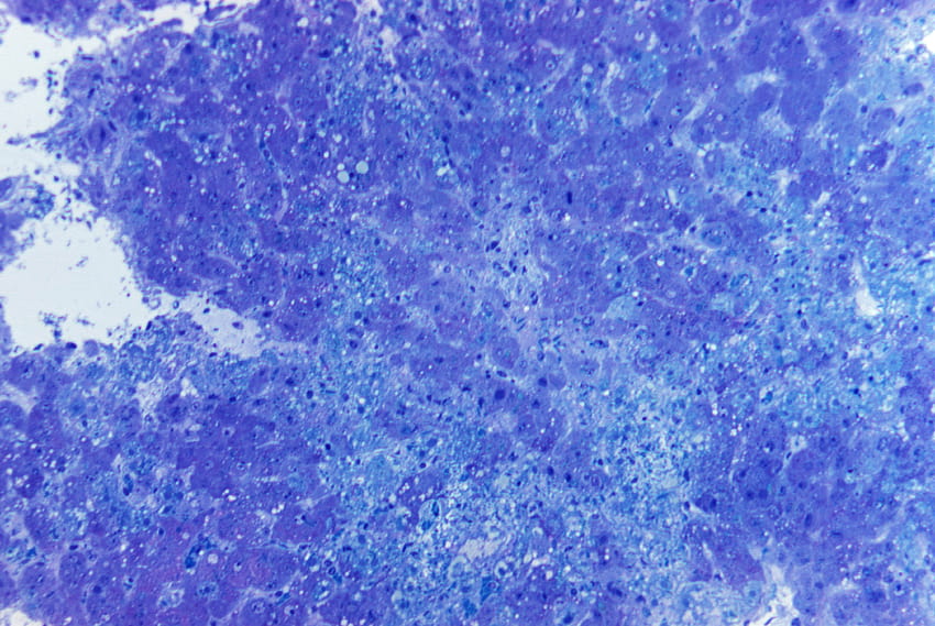 Lassa hemorrhagic fever Lassa virus , public domain, hepatitis HD wallpaper