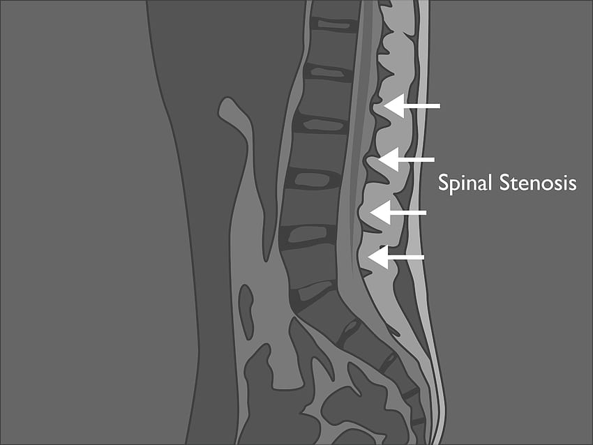 How to Read and Recognize Normal and Abnormal Lumbar MRI Results HD wallpaper