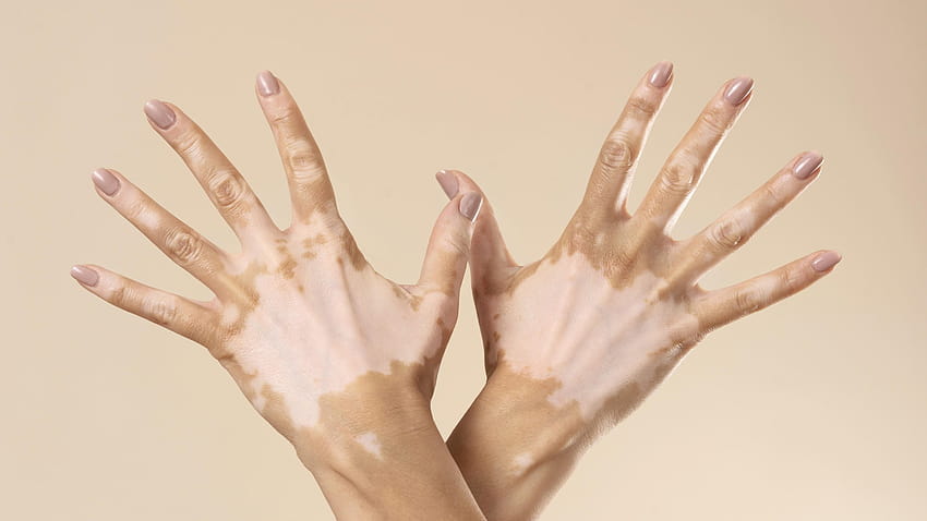 Traitements du vitiligo Fond d'écran HD