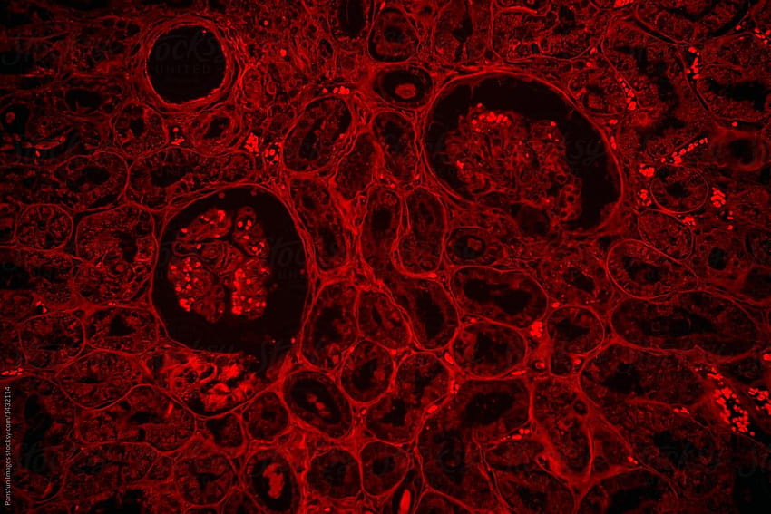 Human kidney proximal tubule epithelial cloudy swelling by Pansfun HD wallpaper