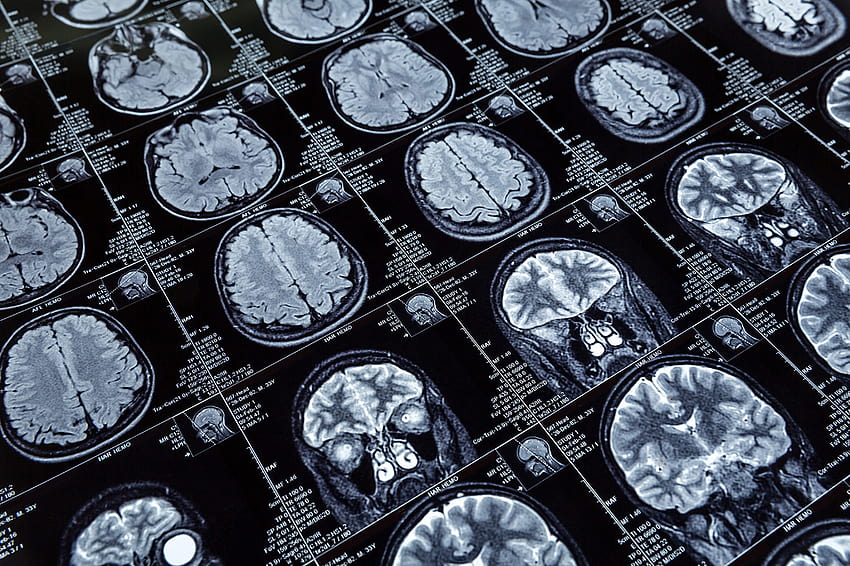 Pour les patients en chirurgie cérébrale, le choix de l'hôpital est crucial lorsqu'une réadmission est nécessaire, la neurochirurgie Fond d'écran HD