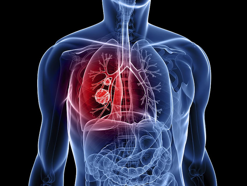 Lung cancer: 7 breakthroughs in research, treatment, diagnosis, lung cancer awareness HD wallpaper