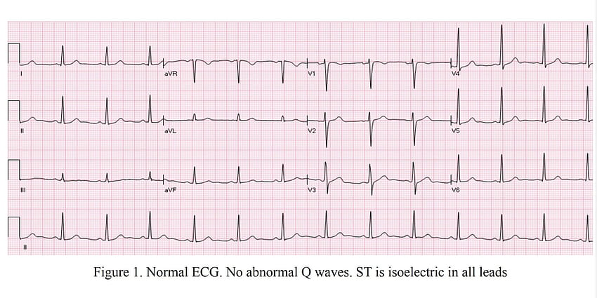 Normales EKG HD-Hintergrundbild