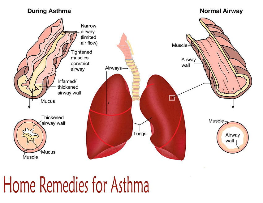 10 Home Remedies for Asthma, asthmatic HD wallpaper